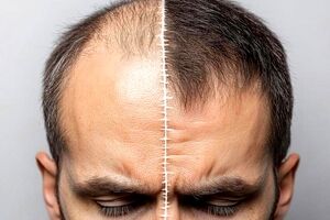 آشنایی با بهترین مرکز کاشت مو | راهنمای کامل انتخاب کلینیک معتبر